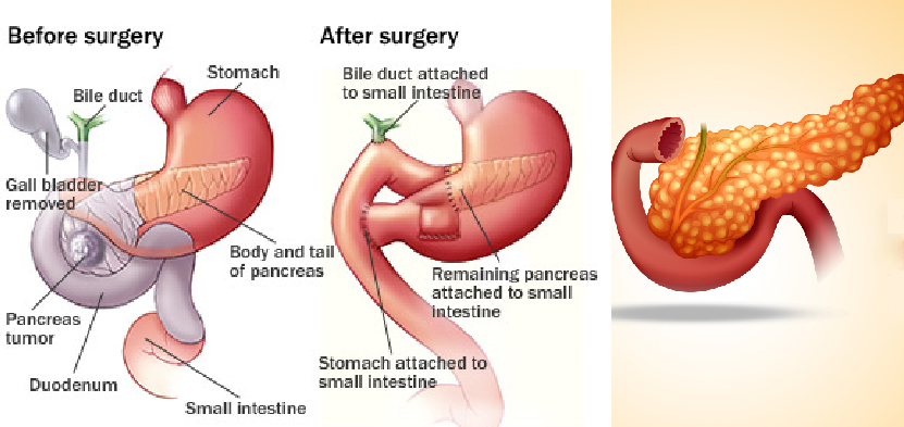 Pancreas Surgery in Ahmedabad, Pancreas Surgery in Gujarat, Pancreas Surgery in Rajasthan, Pancreas Surgery in Jaipur, Pancreas Surgery in Ajmer