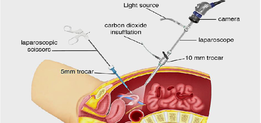 Keyhole Surgery in Ahmedabad