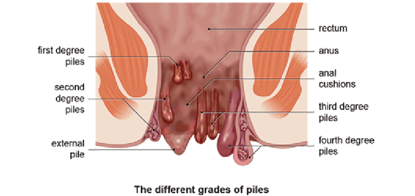 piles surgery in ahmedabad, Piles Hospital in Ahmedabad, Piles Hospital in Gujarat, Piles Hospital Near Me Piles Treatment Doctor in Ahmedabad, Piles Treatment Doctor in Gujarat, Good Doctor For Piles Treatment in Ahmedabad, Good Doctor For Piles Treatment in Gujarat, Piles Treatment in Ahmedabad, Piles Treatment in Gujarat