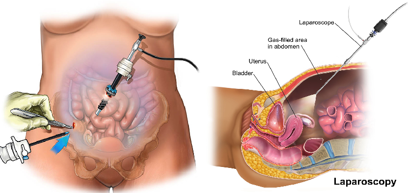 Laparoscopic Surgeon in Ahmedabad, Laparoscopic Surgeon in Gujarat, Laparoscopic Surgeon in Rajasthan, Best Laparoscopic Surgeon in Ahmedabad, Best Laparoscopic Surgeon in Gujarat, Best Laparoscopic Surgeon in Rajasthan 