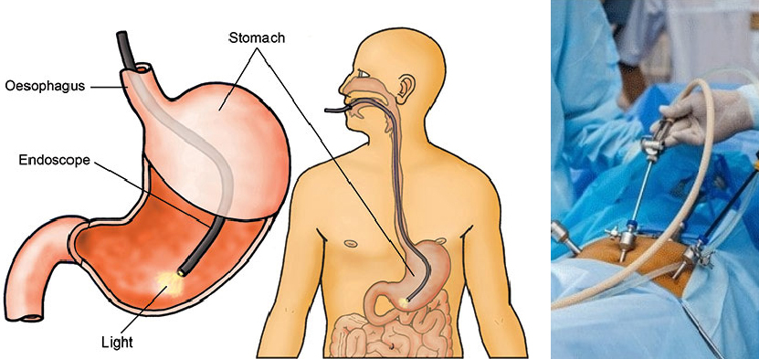 Endoscopic Surgeon in Ahmedabad, Endoscopic Surgeon in Gujarat, Endoscopic Surgeon in Rajasthan