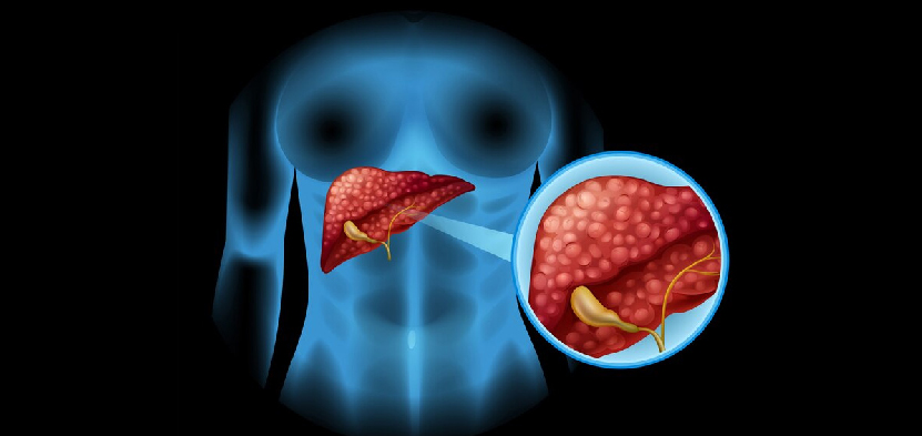 Gallbladder Surgery in Ahmedabad, Gallbladder Surgery in Gujarat, Gallbladder Surgery in Rajasthan