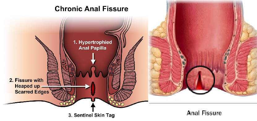 SURGERIES FOR FISTURES AND FISTULA, fistula surgery cost in ahmedabad, Fistula Removal Doctor in Ahmedabad, Fistula Removal Doctor in Gujarat, Fistula Removal Doctor in Rajasthan