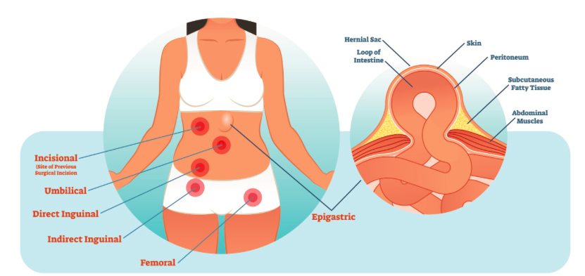 Hernia Surgeon in Ahmedabad, Hernia Surgeon in Gujarat, Hernia Surgeon in Rajasthan, Best Hernia Doctor in Ahmedabad, Best Hernia Doctor in Gujarat, Best Hernia Doctor in Rajasthan, Hernia Doctor in Ahmedabad, Hernia Doctor in Gujarat, Hernia Doctor in Rajasthan